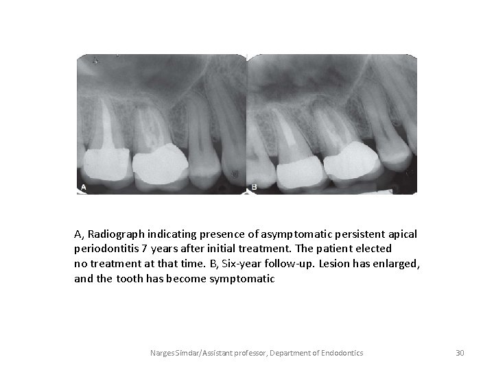 A, Radiograph indicating presence of asymptomatic persistent apical periodontitis 7 years after initial treatment.