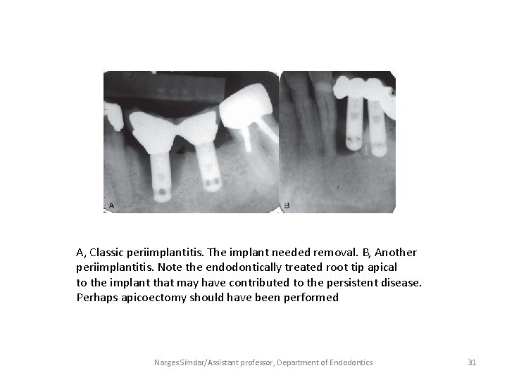 A, Classic periimplantitis. The implant needed removal. B, Another periimplantitis. Note the endodontically treated