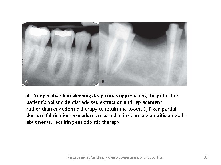 A, Preoperative film showing deep caries approaching the pulp. The patient’s holistic dentist advised