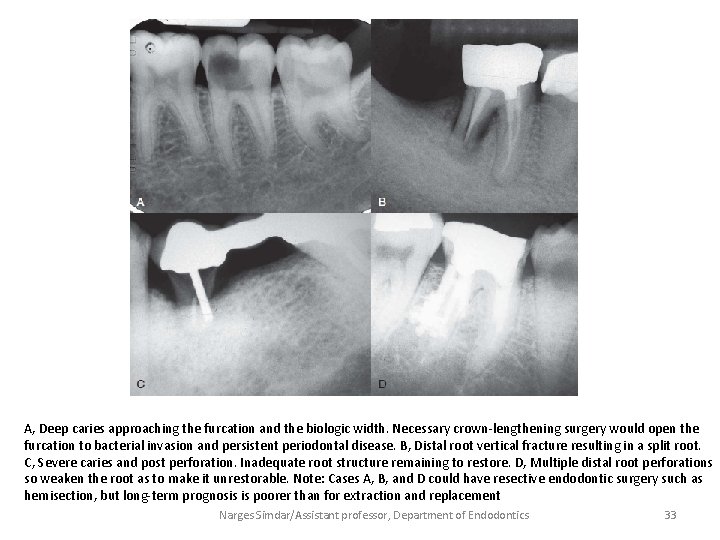 A, Deep caries approaching the furcation and the biologic width. Necessary crown-lengthening surgery would