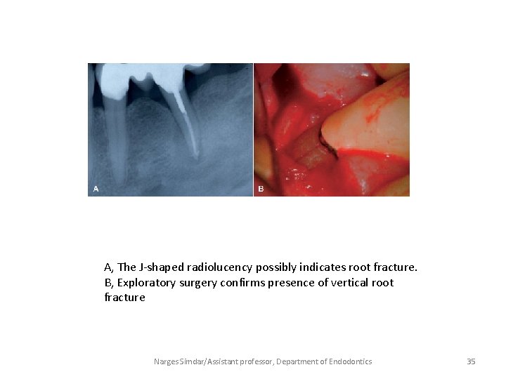 A, The J-shaped radiolucency possibly indicates root fracture. B, Exploratory surgery confirms presence of