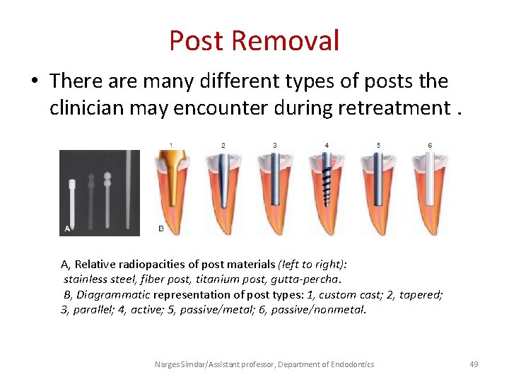 Post Removal • There are many different types of posts the clinician may encounter