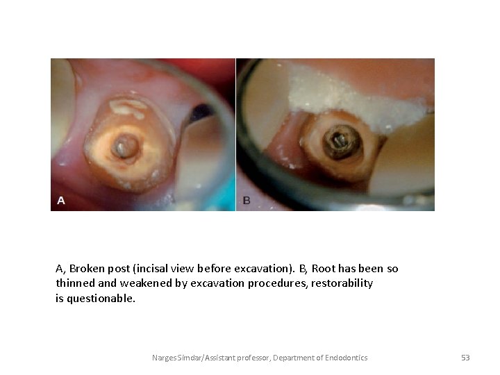 A, Broken post (incisal view before excavation). B, Root has been so thinned and