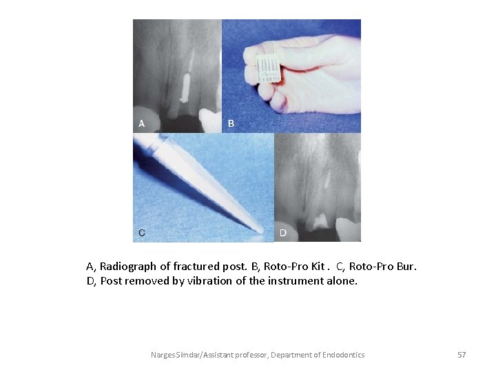 A, Radiograph of fractured post. B, Roto-Pro Kit. C, Roto-Pro Bur. D, Post removed