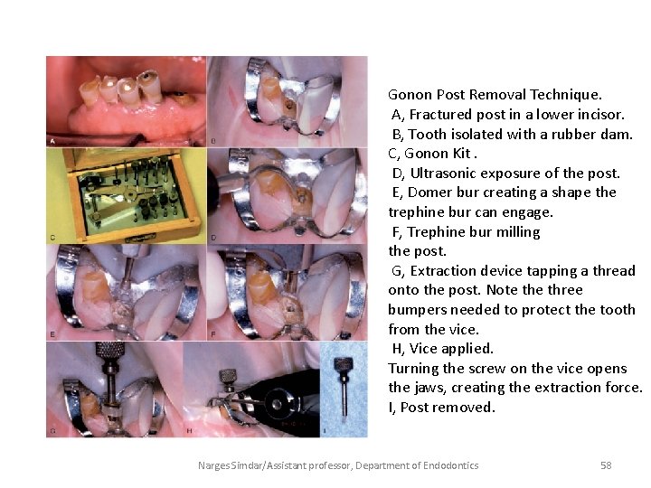 Gonon Post Removal Technique. A, Fractured post in a lower incisor. B, Tooth isolated