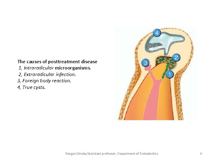 The causes of posttreatment disease 1, Intraradicular microorganisms. 2, Extraradicular infection. 3, Foreign body