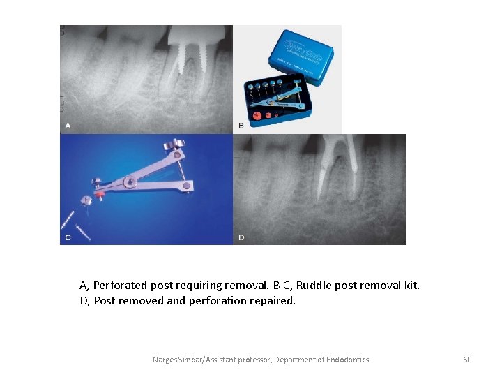 A, Perforated post requiring removal. B-C, Ruddle post removal kit. D, Post removed and