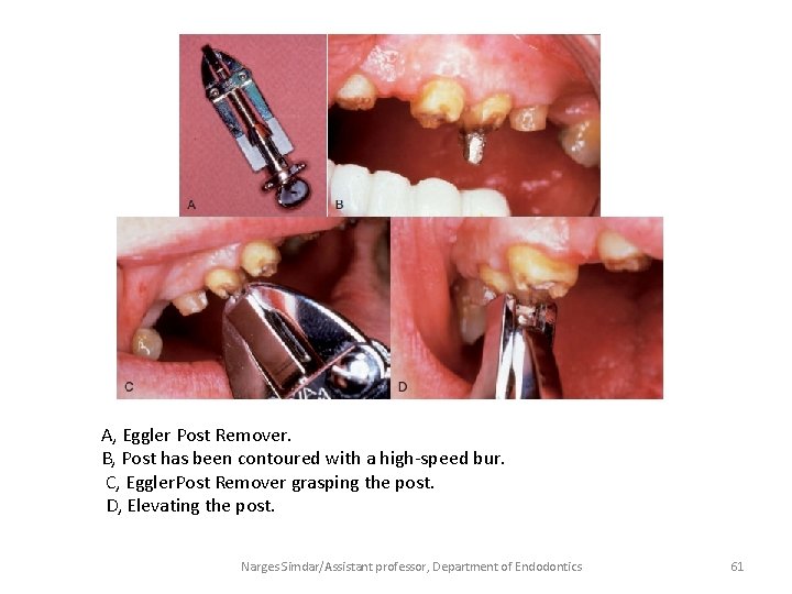 A, Eggler Post Remover. B, Post has been contoured with a high-speed bur. C,