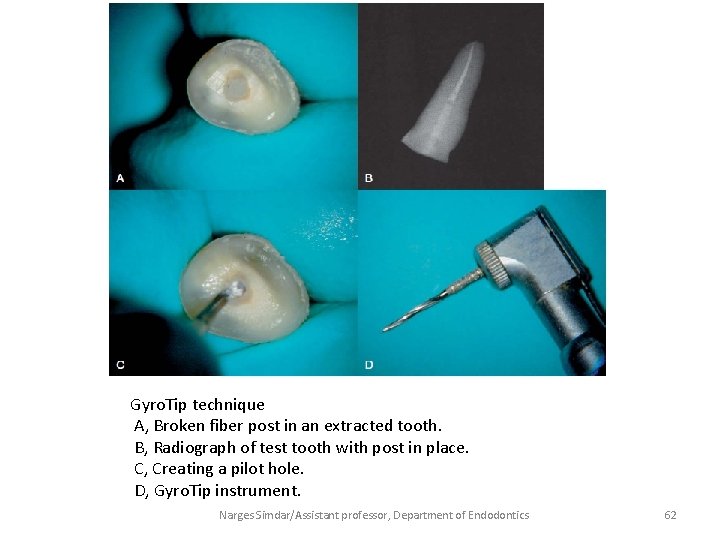 Gyro. Tip technique A, Broken fiber post in an extracted tooth. B, Radiograph of