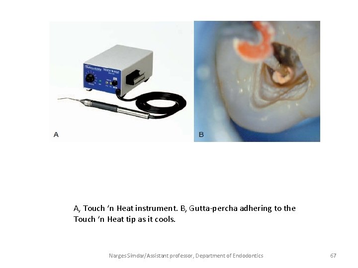 A, Touch ’n Heat instrument. B, Gutta-percha adhering to the Touch ’n Heat tip