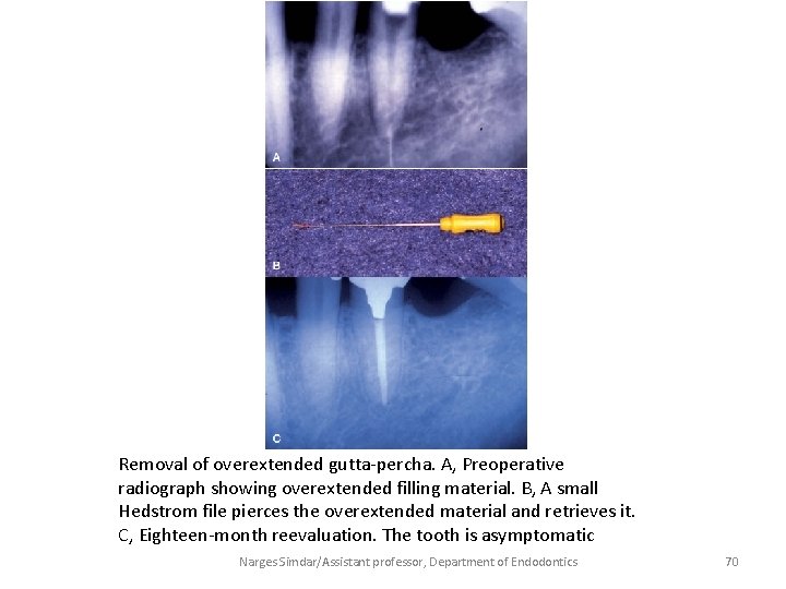 Removal of overextended gutta-percha. A, Preoperative radiograph showing overextended filling material. B, A small