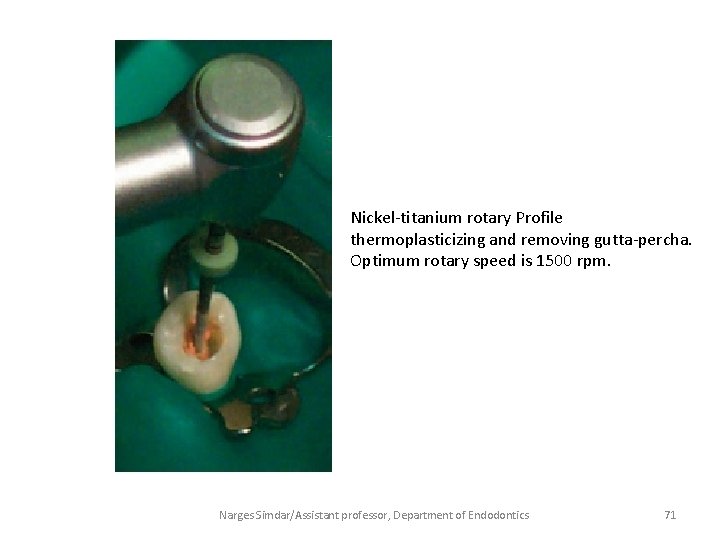 Nickel-titanium rotary Profile thermoplasticizing and removing gutta-percha. Optimum rotary speed is 1500 rpm. Narges