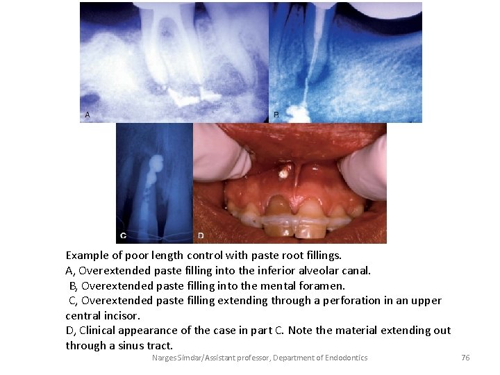 Example of poor length control with paste root fillings. A, Overextended paste filling into