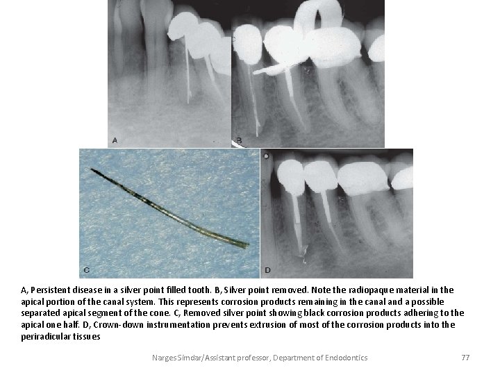 A, Persistent disease in a silver point filled tooth. B, Silver point removed. Note