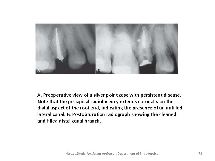 A, Preoperative view of a silver point case with persistent disease. Note that the