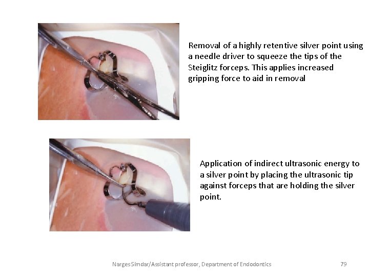 Removal of a highly retentive silver point using a needle driver to squeeze the