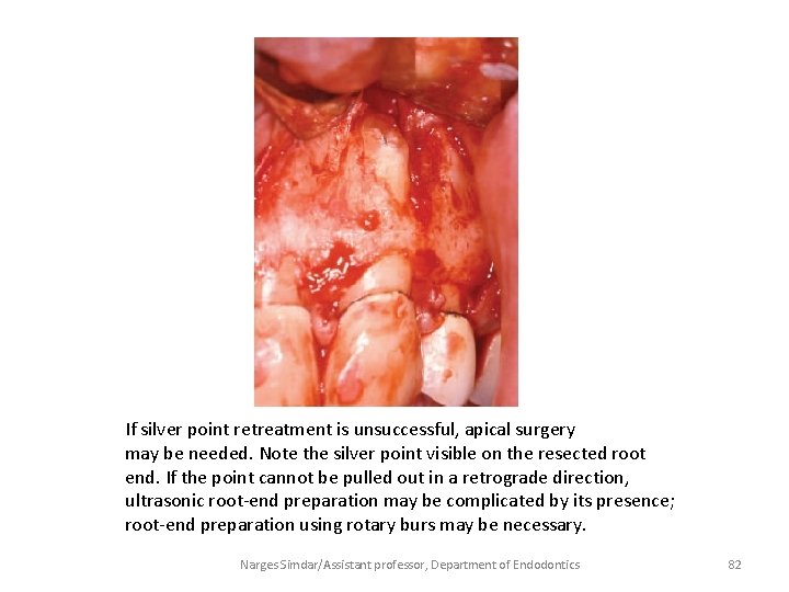 If silver point retreatment is unsuccessful, apical surgery may be needed. Note the silver