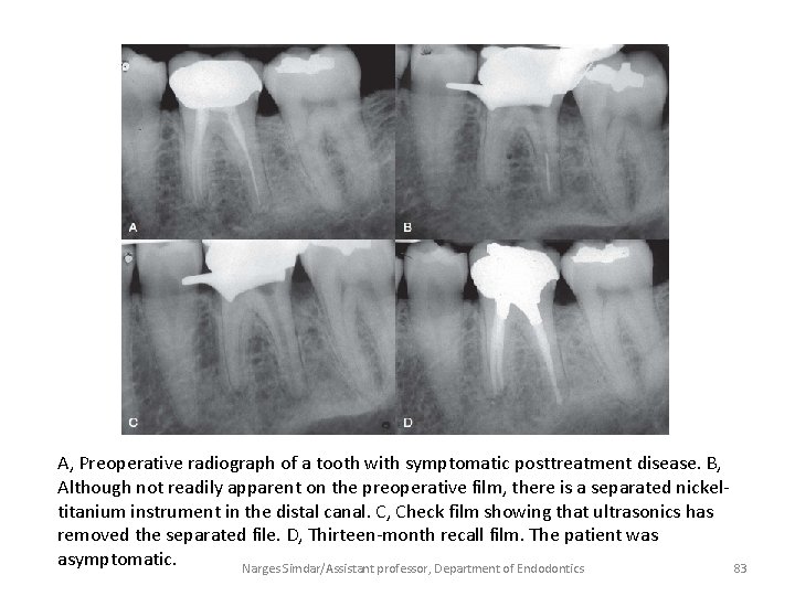 A, Preoperative radiograph of a tooth with symptomatic posttreatment disease. B, Although not readily