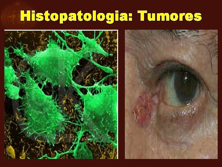 Histopatologia: Tumores 