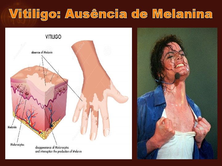 Vitiligo: Ausência de Melanina 