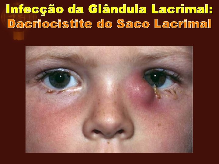 Infecção da Glândula Lacrimal: Dacriocistite do Saco Lacrimal 
