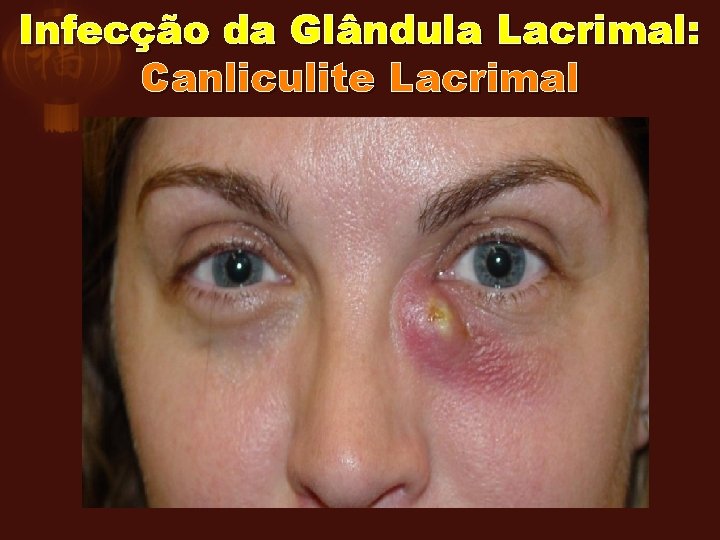 Infecção da Glândula Lacrimal: Canliculite Lacrimal 