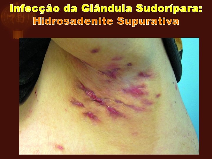 Infecção da Glândula Sudorípara: Hidrosadenite Supurativa 