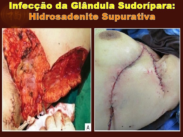 Infecção da Glândula Sudorípara: Hidrosadenite Supurativa 