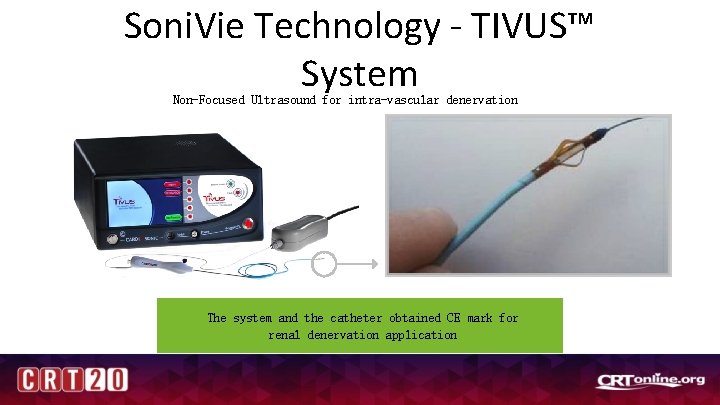 Soni. Vie Technology - TIVUS™ System Non-Focused Ultrasound for intra-vascular denervation The system and