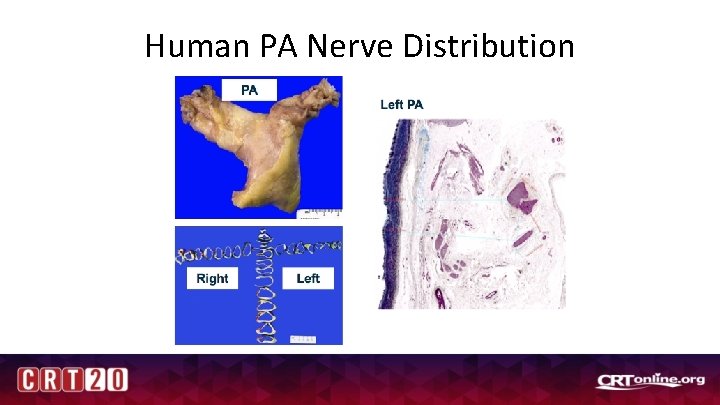 Human PA Nerve Distribution 