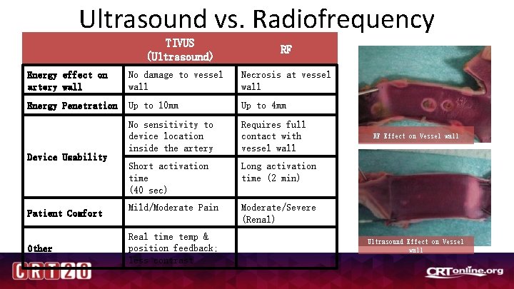 Ultrasound vs. Radiofrequency Ablation TIVUS (Ultrasound) RF Energy effect on artery wall No damage