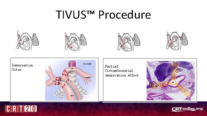 TIVUS™ Procedure RHC - Right Heart catheterization Denervation Sites Partial Circumferential denervation effect 