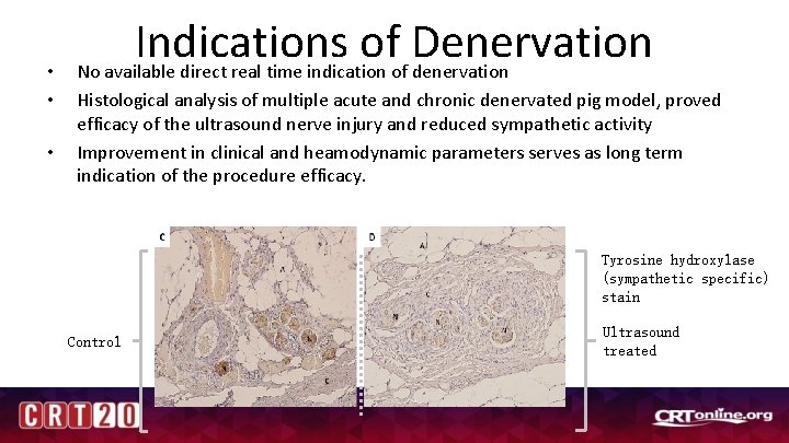  • • • Indications of Denervation No available direct real time indication of