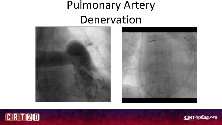Pulmonary Artery Denervation 