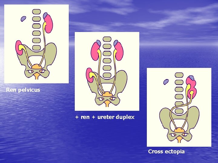Ren pelvicus + ren + ureter duplex Cross ectopia 