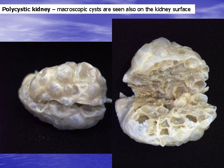 Polycystic kidney – macroscopic cysts are seen also on the kidney surface 