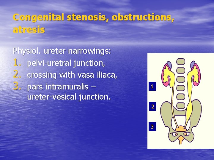 Congenital stenosis, obstructions, atresis Physiol. ureter narrowings: 1. pelvi-uretral junction, 2. crossing with vasa