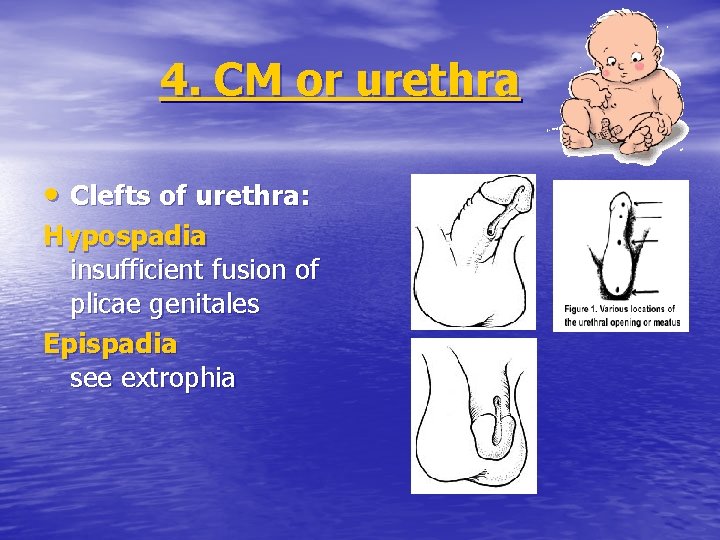 4. CM or urethra • Clefts of urethra: Hypospadia insufficient fusion of plicae genitales