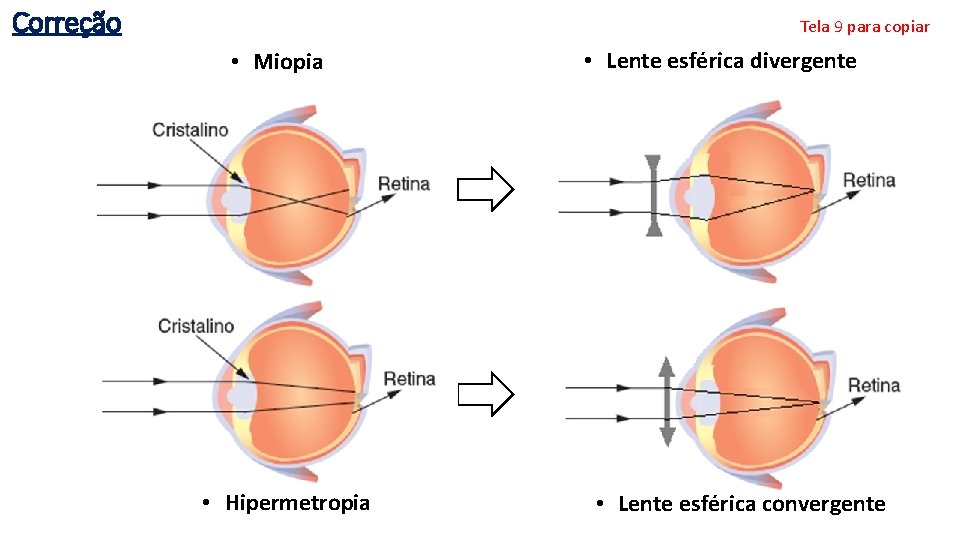 Correção Tela 9 para copiar • Miopia • Hipermetropia • Lente esférica divergente •