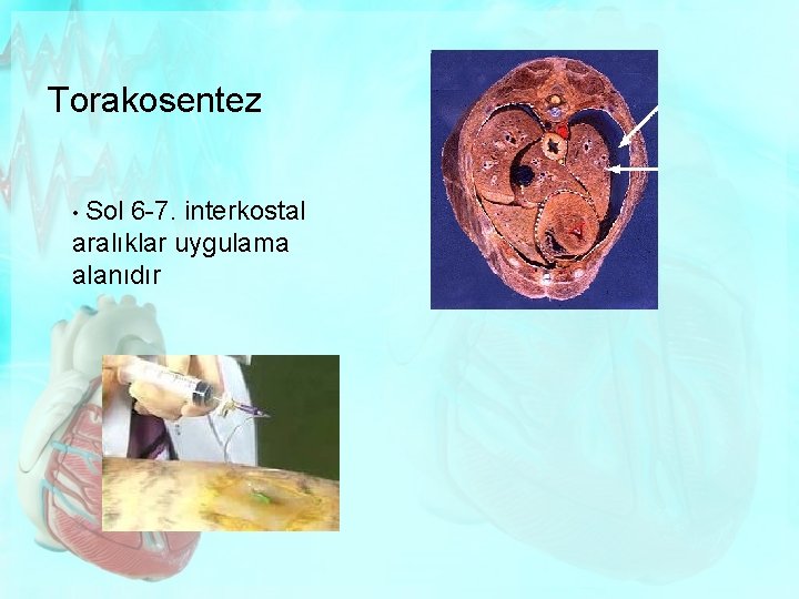 Torakosentez • Sol 6 -7. interkostal aralıklar uygulama alanıdır 