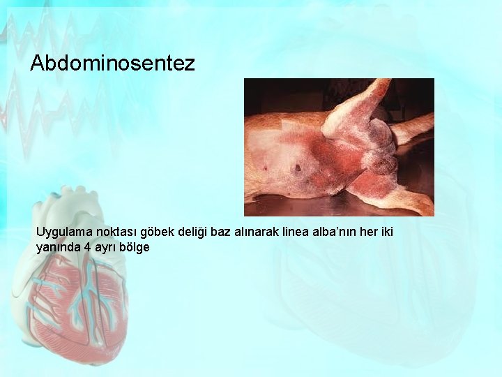 Abdominosentez Uygulama noktası göbek deliği baz alınarak linea alba’nın her iki yanında 4 ayrı