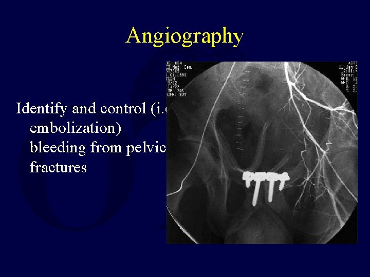 Angiography Identify and control (i. e. embolization) bleeding from pelvic fractures 