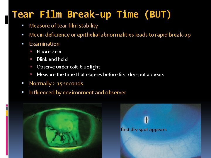 Tear Film Break-up Time (BUT) Measure of tear film stability Mucin deficiency or epithelial