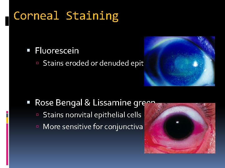 Corneal Staining Fluorescein Stains eroded or denuded epithelium Rose Bengal & Lissamine green Stains