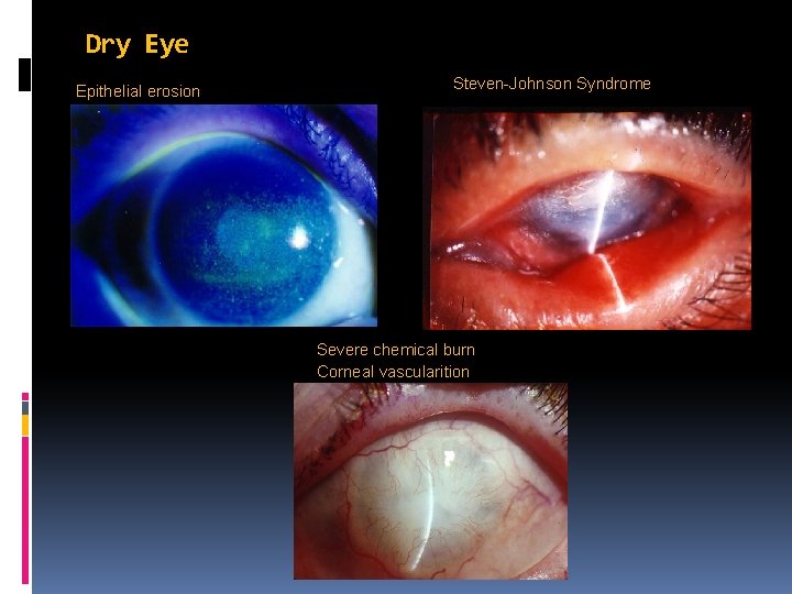Dry Eye Epithelial erosion Steven-Johnson Syndrome Severe chemical burn Corneal vascularition 