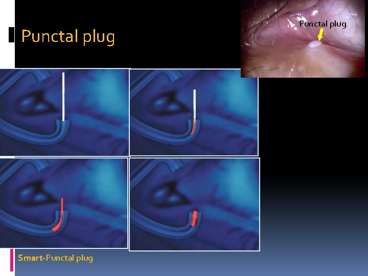 Punctal plug Smart-Punctal plug 