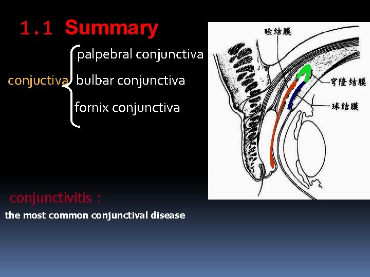 1. 1 Summary palpebral conjunctiva conjuctiva bulbar conjunctiva fornix conjunctiva conjunctivitis : the most