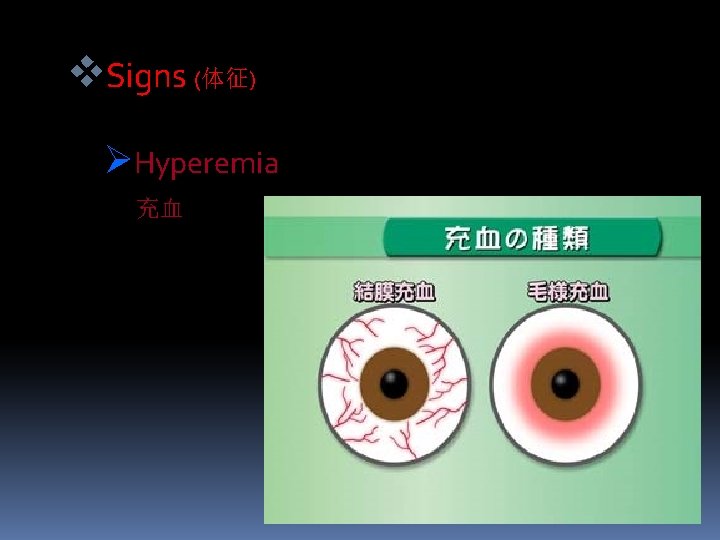 v. Signs (体征) ØHyperemia 充血 