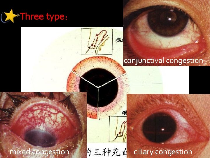 Three type： conjunctival congestion mixed congestion ciliary congestion 