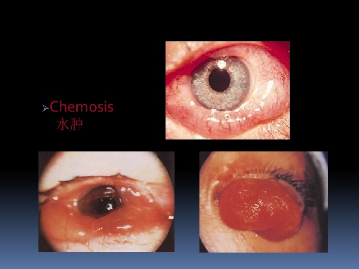 Ø Chemosis 水肿 